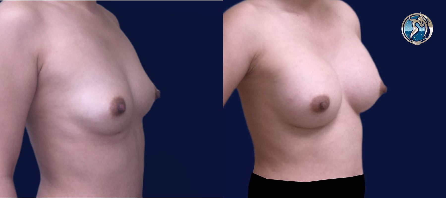 Before and after Breast Augmentation case 46088 - Angle 4