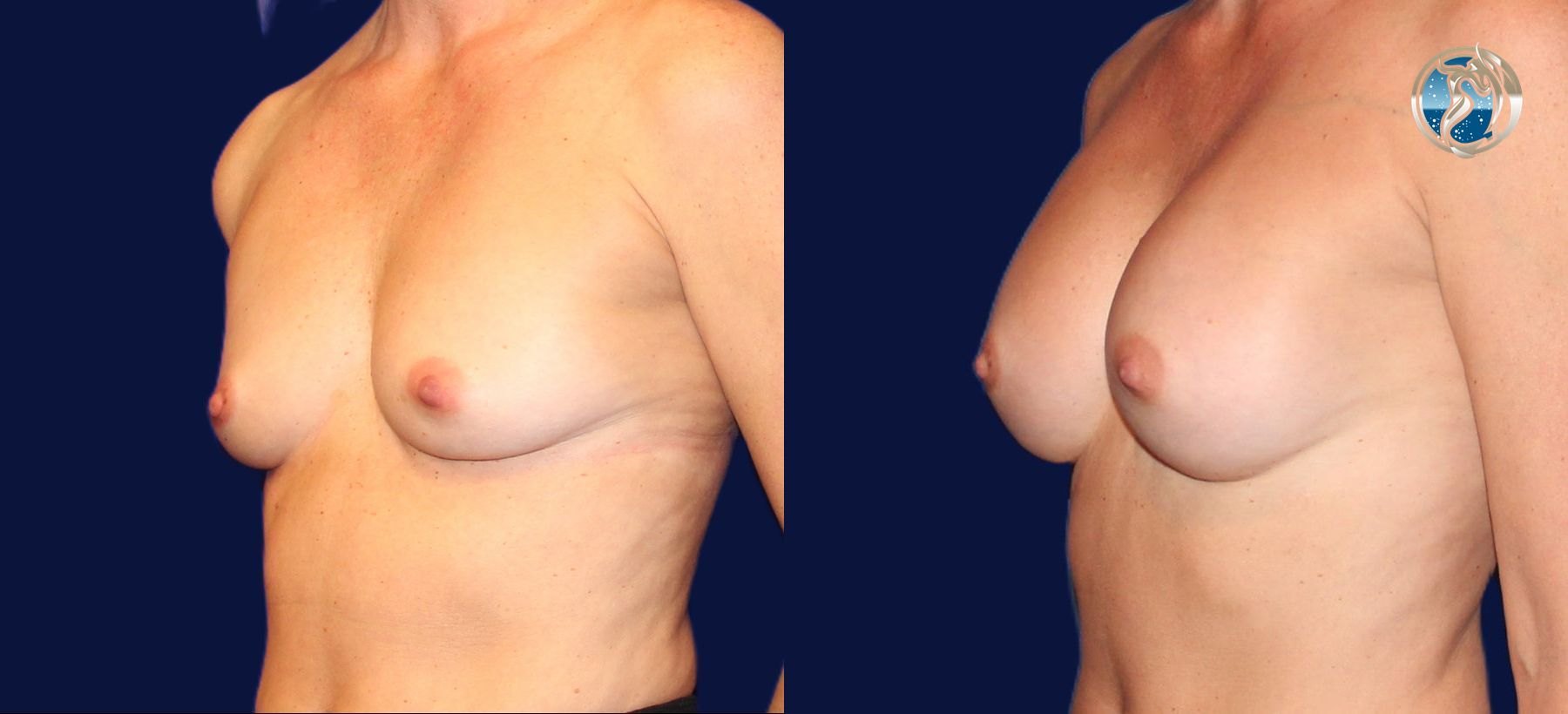 Before and after photo set of breast augmentation by Dr. Orna Fisher in San Mateo, CA - Angle 2
