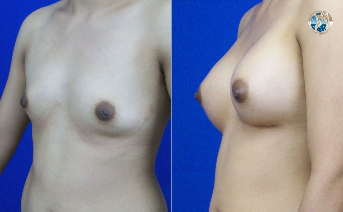 Before and after photo set of breast augmentation by Dr. Orna Fisher in San Mateo, CA - Angle 2