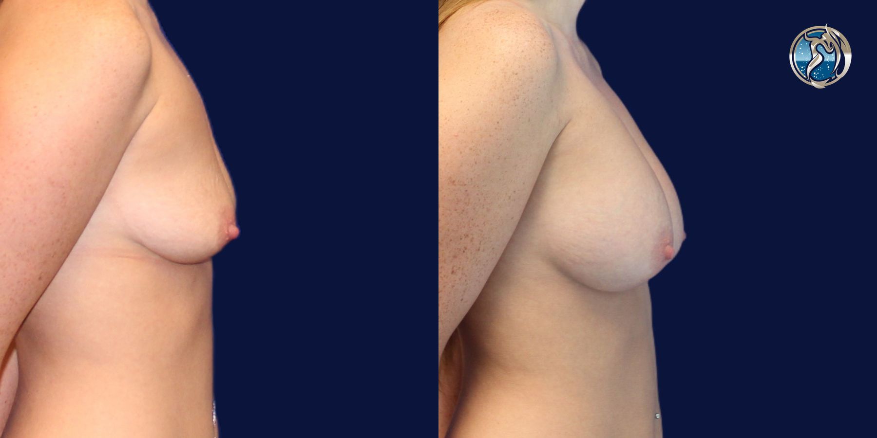 Before and after photo set of breast augmentation by Dr. Orna Fisher in San Mateo, CA - Angle 5