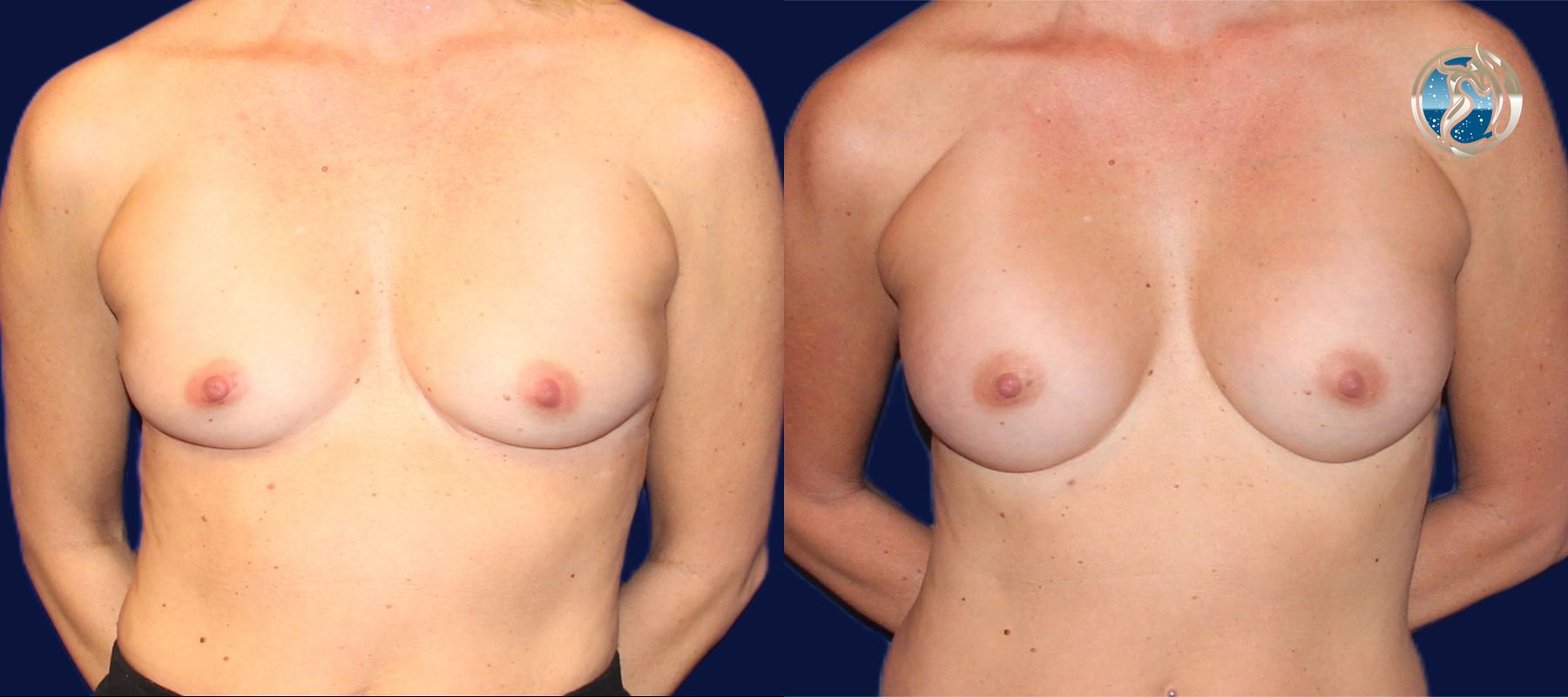 Before and after photo set of breast augmentation by Dr. Orna Fisher in San Mateo, CA