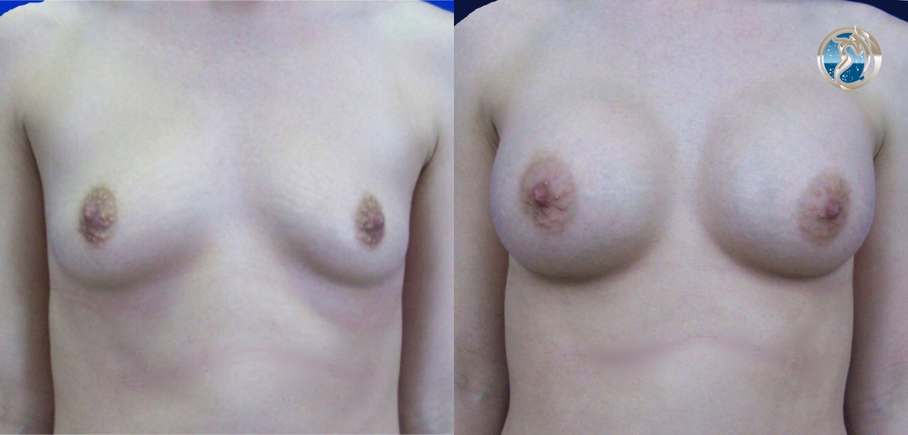 Before and after photo set of breast augmentation by Dr. Orna Fisher in San Mateo, CA