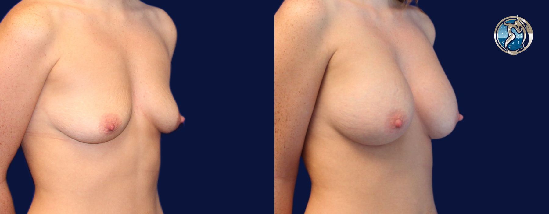 Before and after photo set of breast augmentation by Dr. Orna Fisher in San Mateo, CA - Angle 4