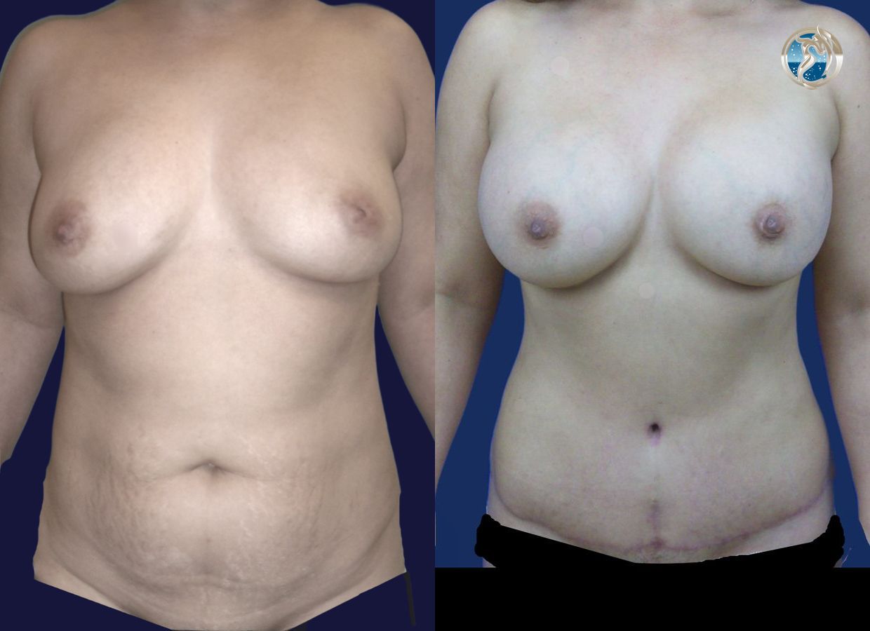 Before and after Combined Abdominal and Breast rejuvenation case 43772