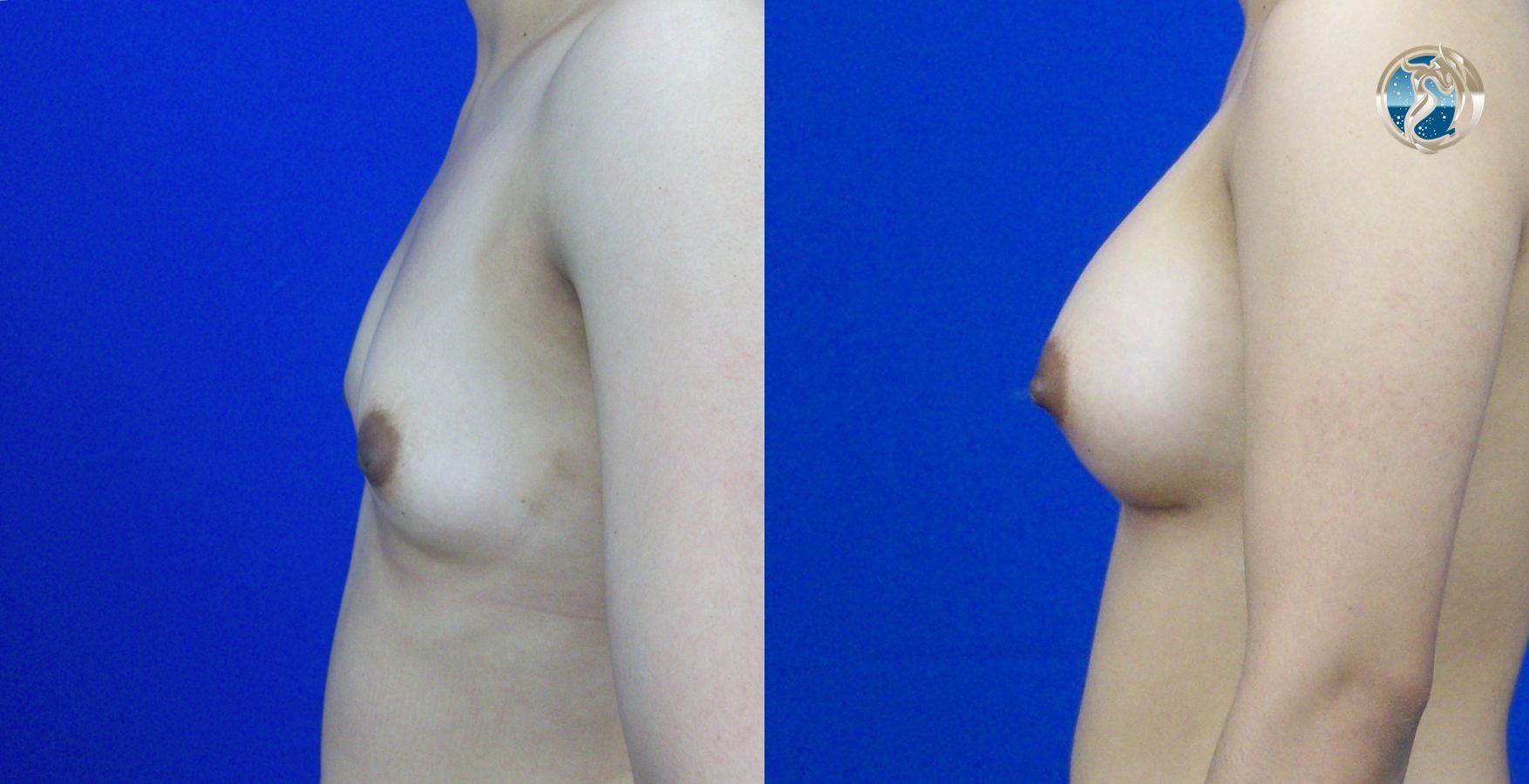 Before and after photo set of breast augmentation by Dr. Orna Fisher in San Mateo, CA - Angle 3