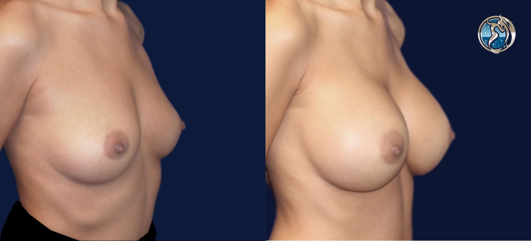 Before and after photo set of breast augmentation by Dr. Orna Fisher in San Mateo, CA - Angle 4