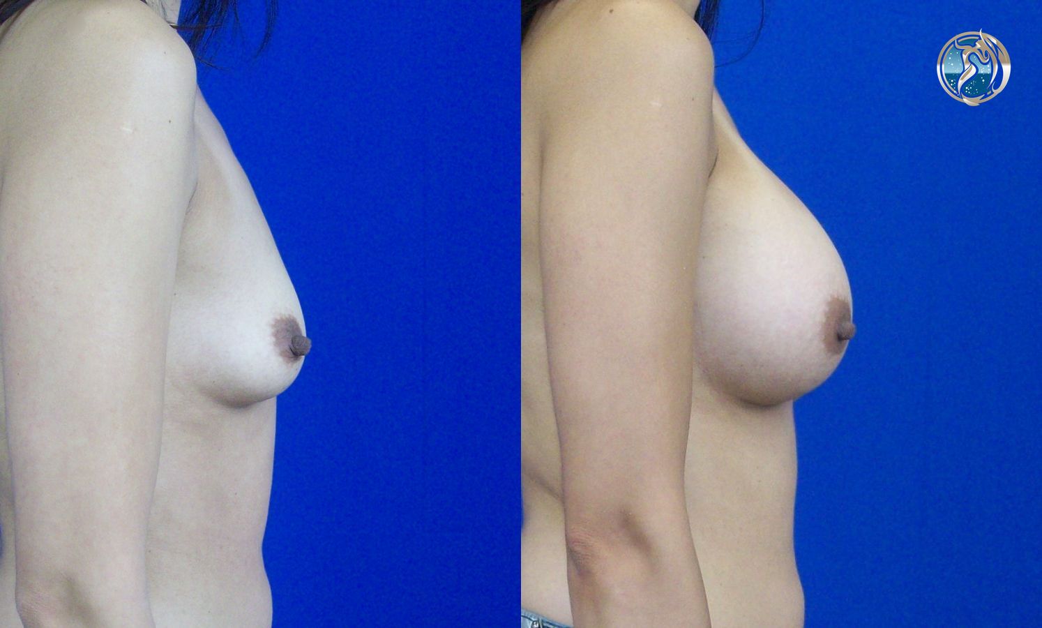 Before and after photo set of breast augmentation by Dr. Orna Fisher in San Mateo, CA - Angle 5