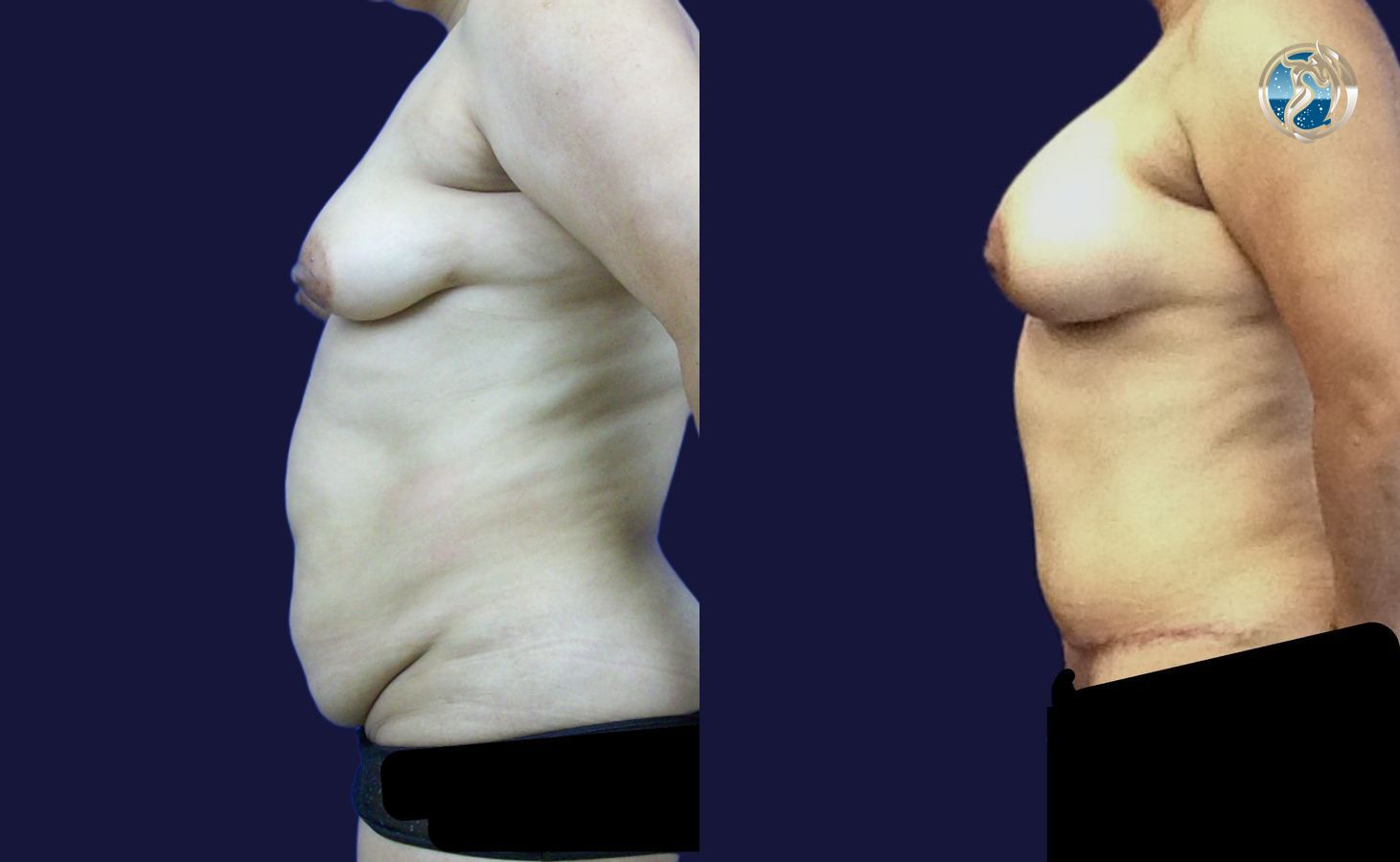 Before and after Combined Abdominal and Breast rejuvenation case 43770 - Angle 5