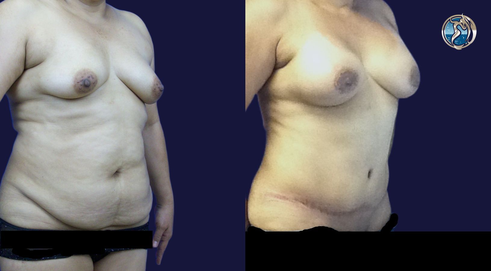 Before and after Combined Abdominal and Breast rejuvenation case 43770 - Angle 2