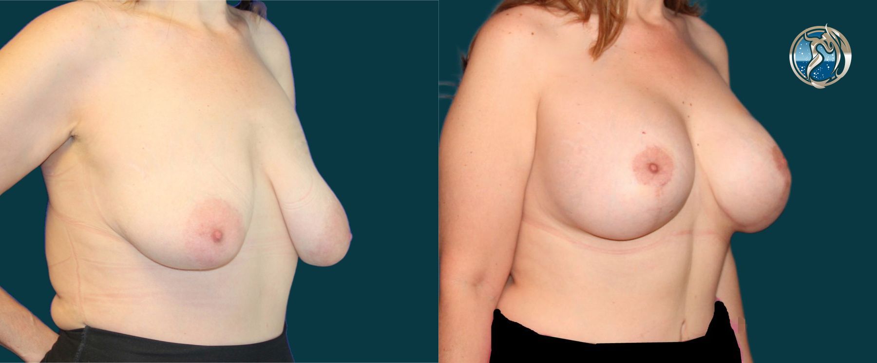 Before and after photo set of breast augmentation and breast lift by Dr. Orna Fisher in San Mateo, CA - Angle 5