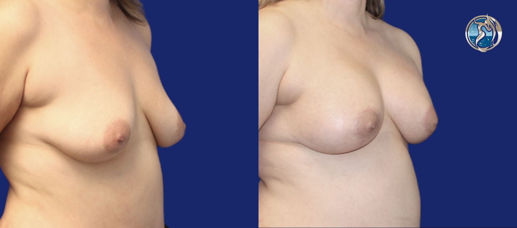 Before and after Breast Augmentation Mastopexy case 43798 - Angle 4