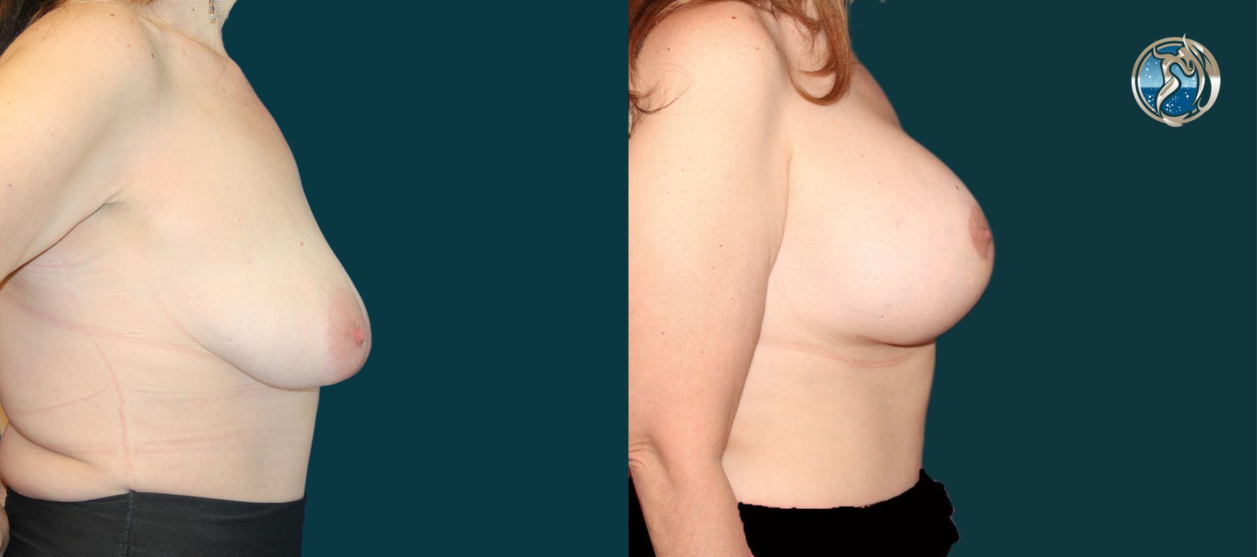 Before and after photo set of breast augmentation and breast lift by Dr. Orna Fisher in San Mateo, CA - Angle 6