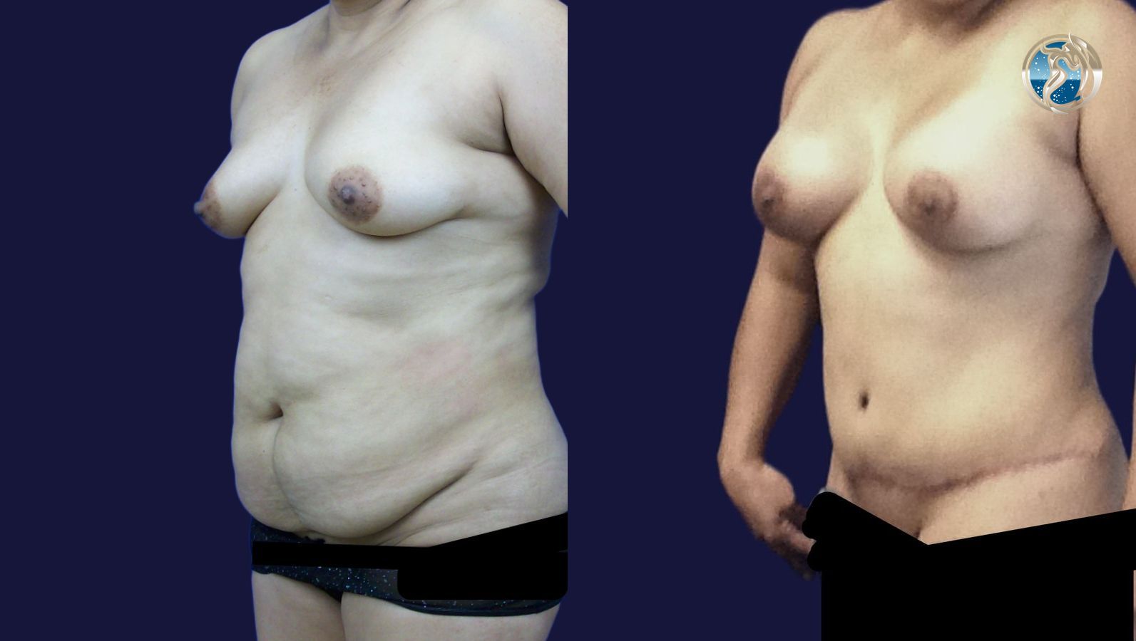 Before and after Combined Abdominal and Breast rejuvenation case 43770 - Angle 4