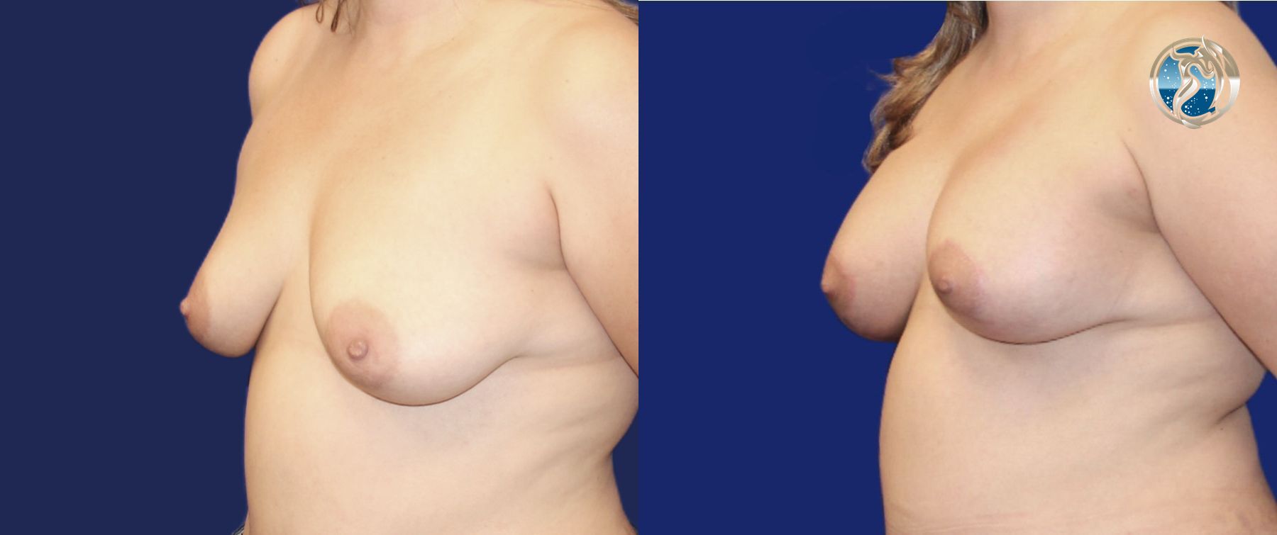 Before and after Breast Augmentation Mastopexy case 43798 - Angle 2
