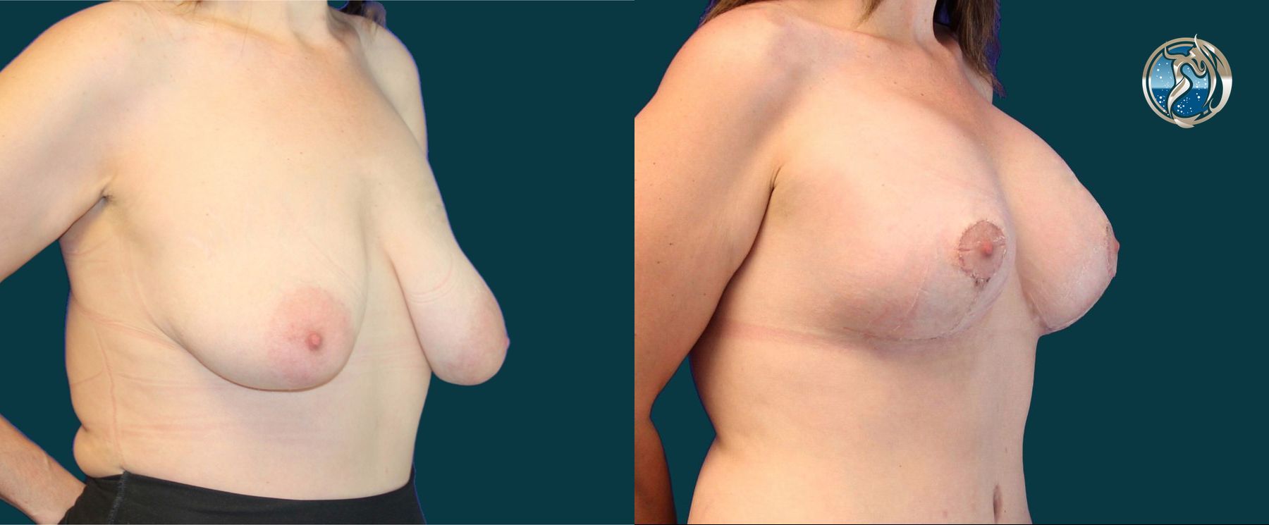 Before and after photo set of breast augmentation and breast lift by Dr. Orna Fisher in San Mateo, CA - Angle 2
