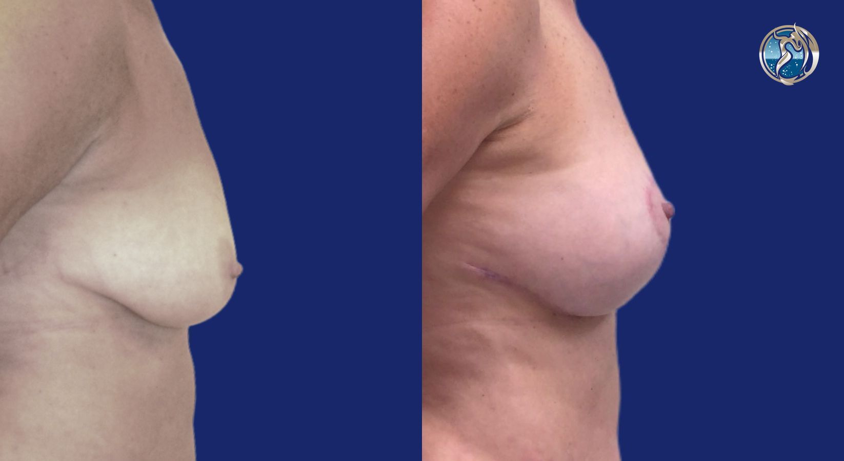 Before and after photo set of Breast lift with small implant augmentation by Dr. Orna Fisher in San Mateo, CA - Angle 2