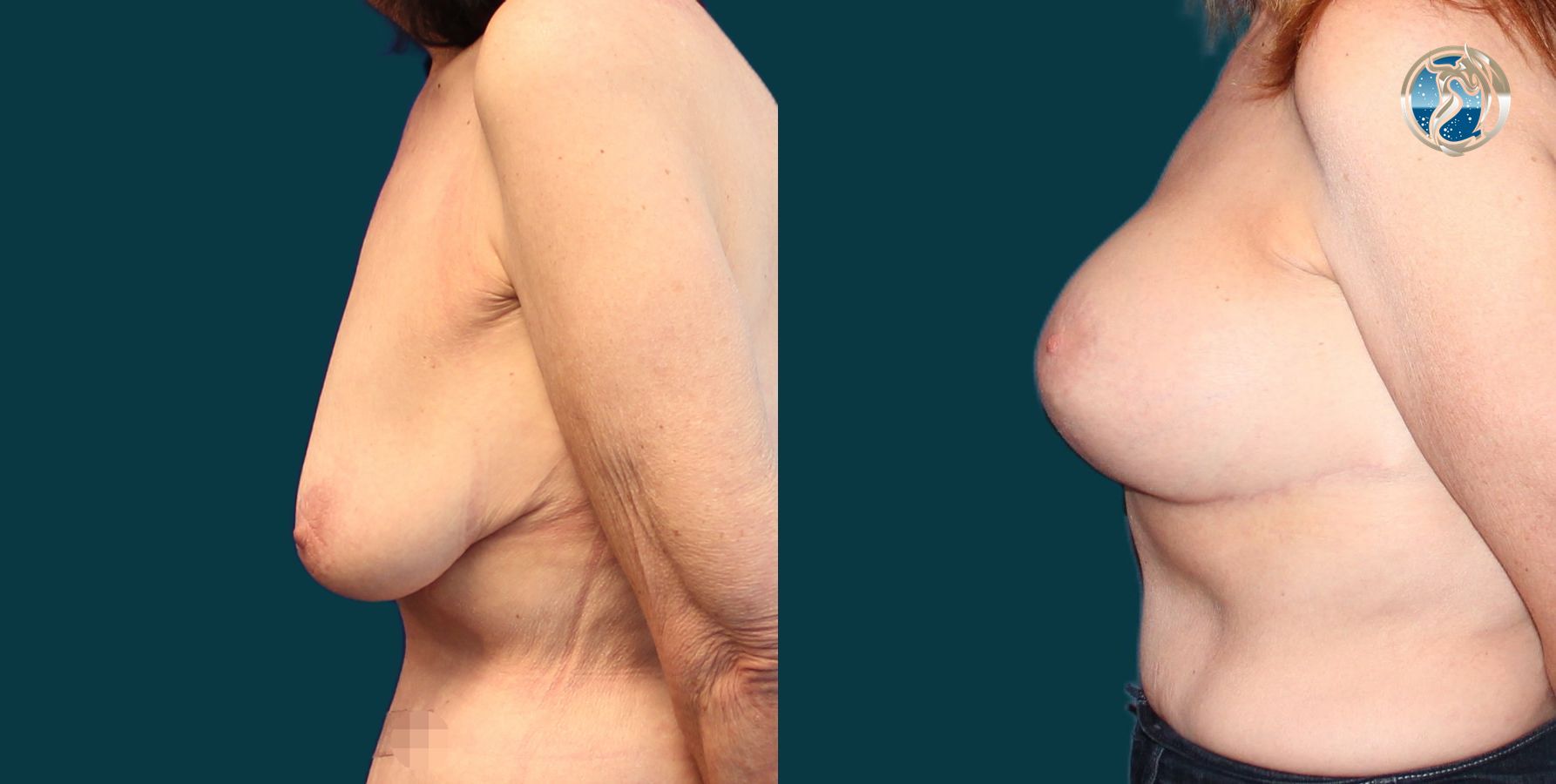 Before and after photo set of breast lift and augmentation by Dr. Orna Fisher in San Mateo, CA - Angle 2