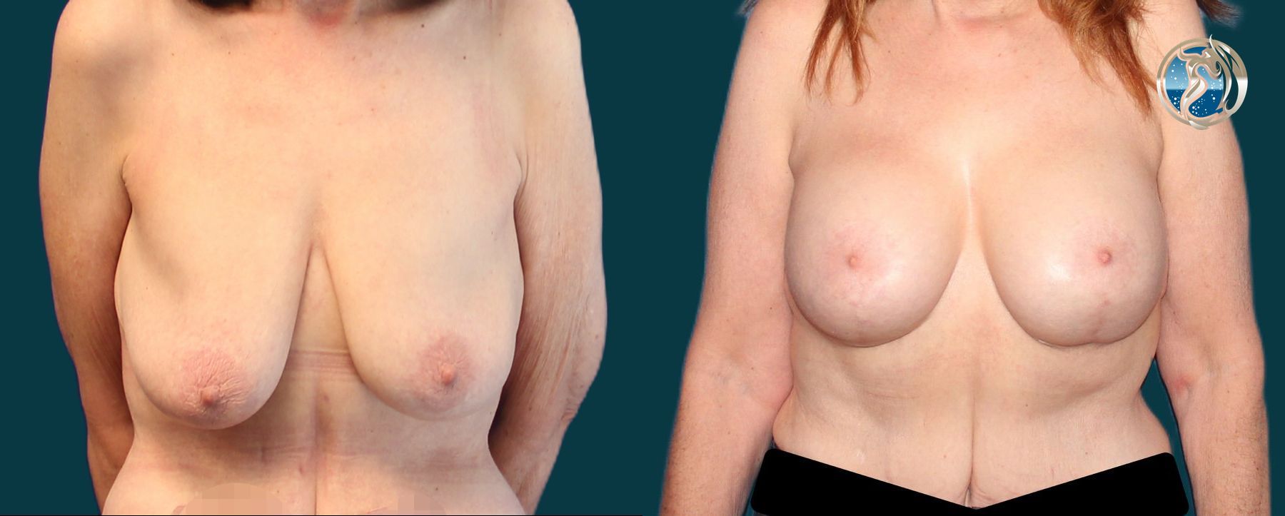 Before and after photo set of breast lift and augmentation by Dr. Orna Fisher in San Mateo, CA