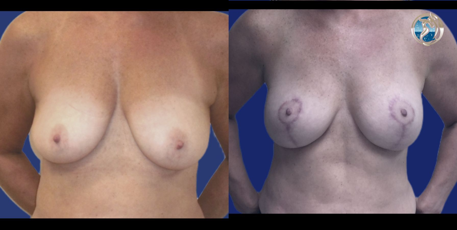 Before and after photo set of Breast lift with small implant augmentation by Dr. Orna Fisher in San Mateo, CA