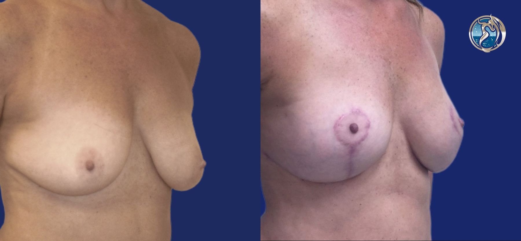 Before and after photo set of Breast lift with small implant augmentation by Dr. Orna Fisher in San Mateo, CA - Angle 3