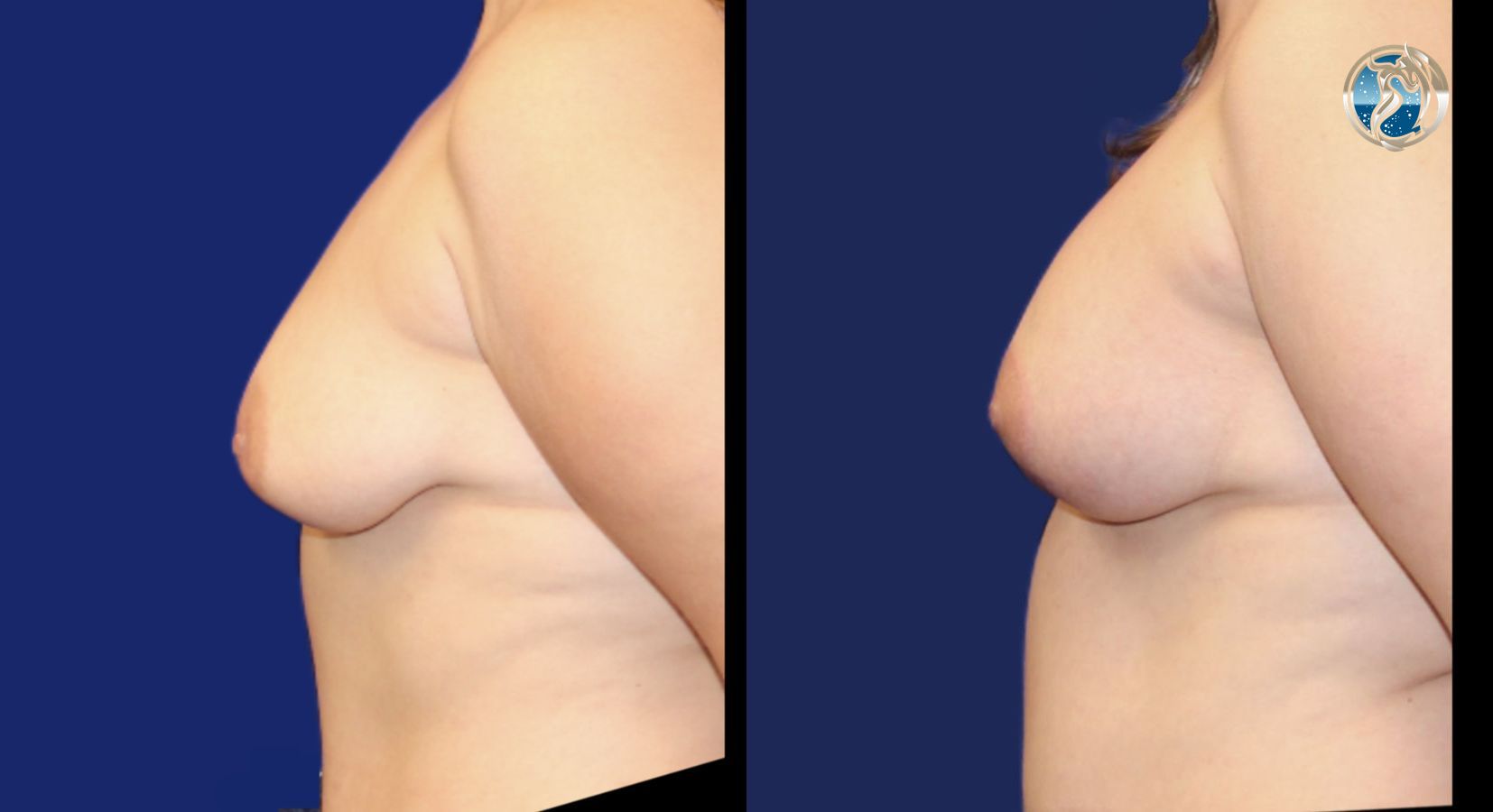 Before and after Breast Augmentation Mastopexy case 43798 - Angle 3