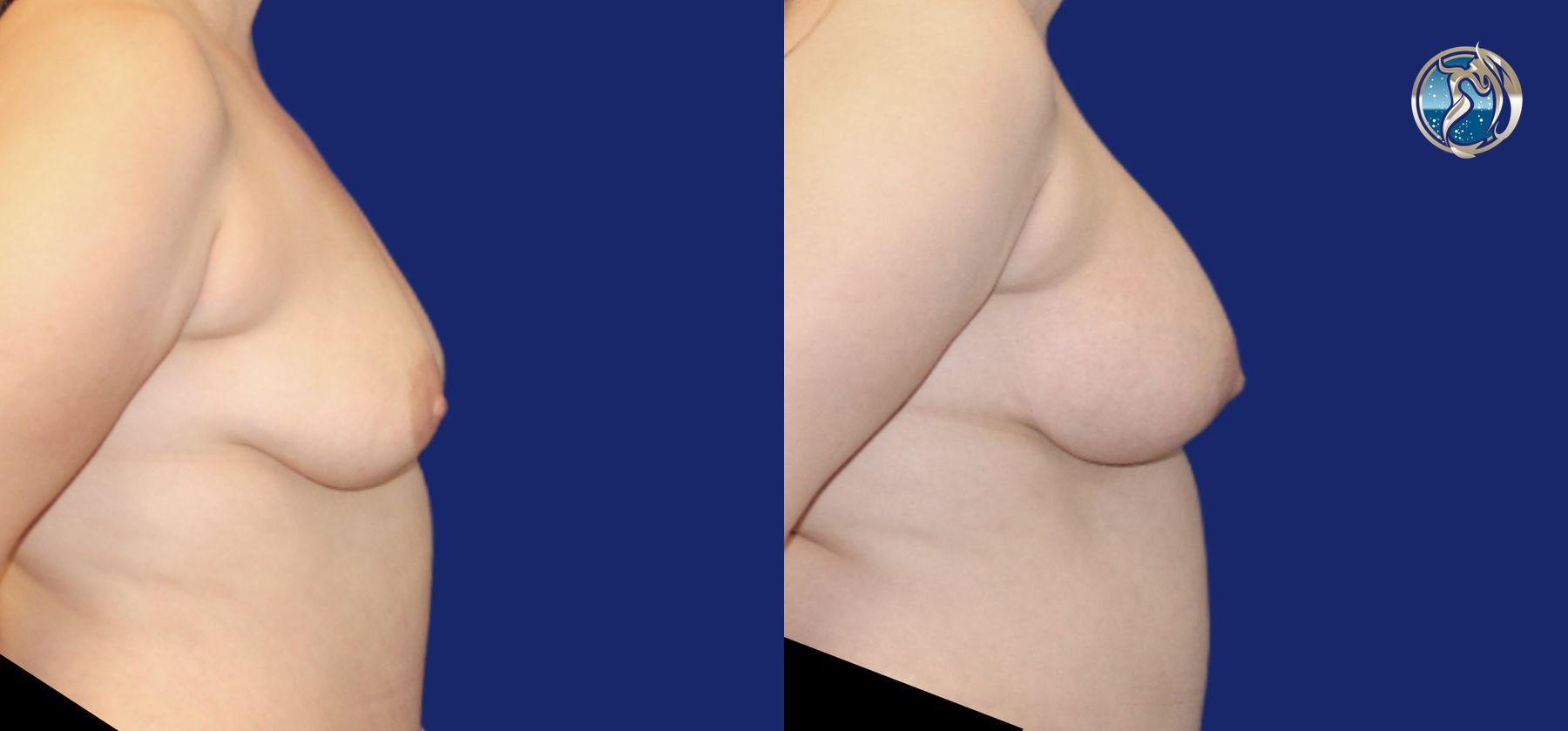 Before and after Breast Augmentation Mastopexy case 43798 - Angle 5