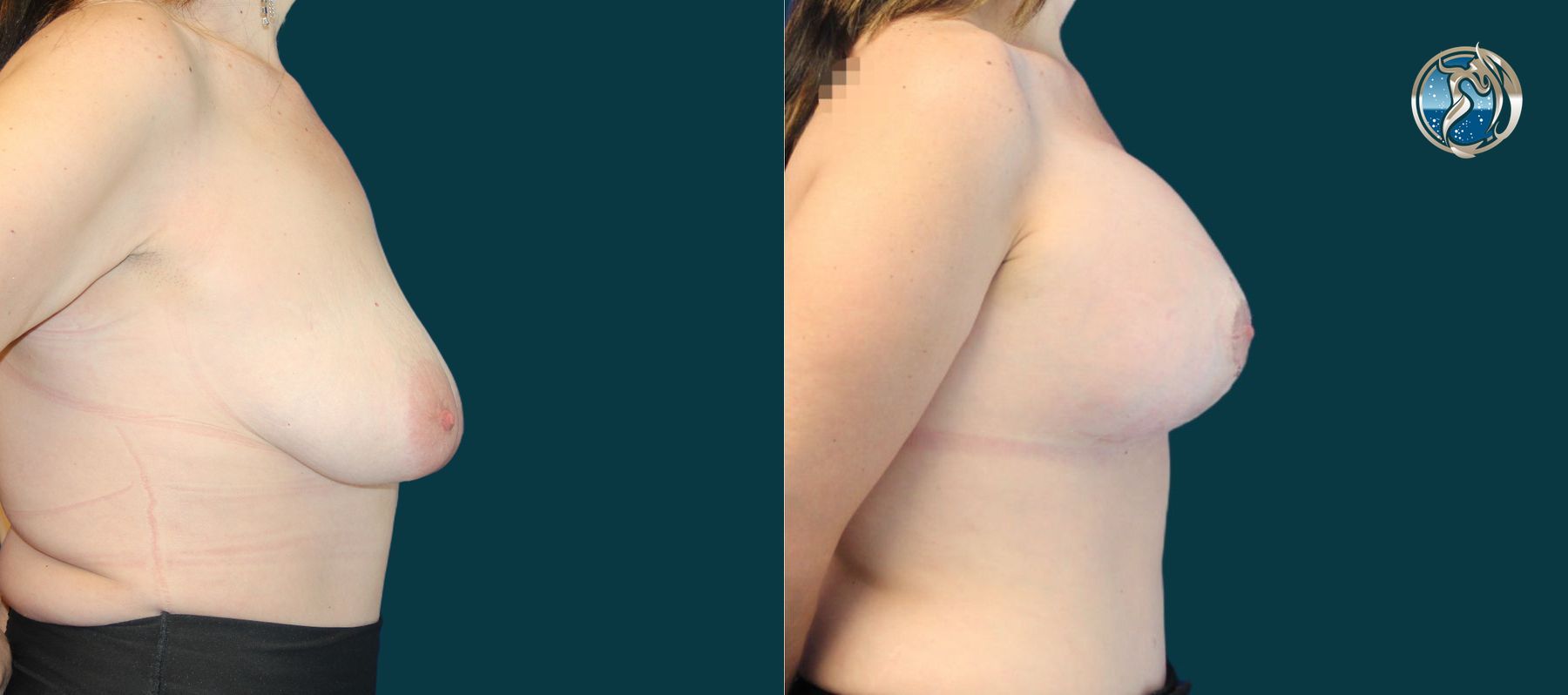 Before and after photo set of breast augmentation and breast lift by Dr. Orna Fisher in San Mateo, CA - Angle 3
