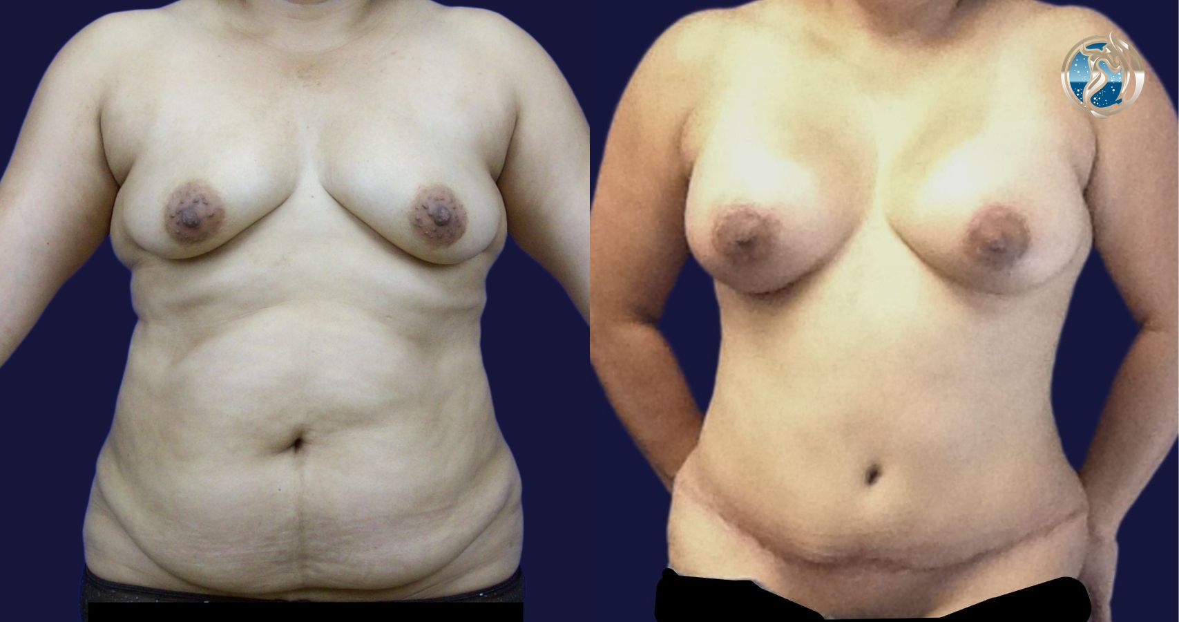 Before and after Combined Abdominal and Breast rejuvenation case 43770