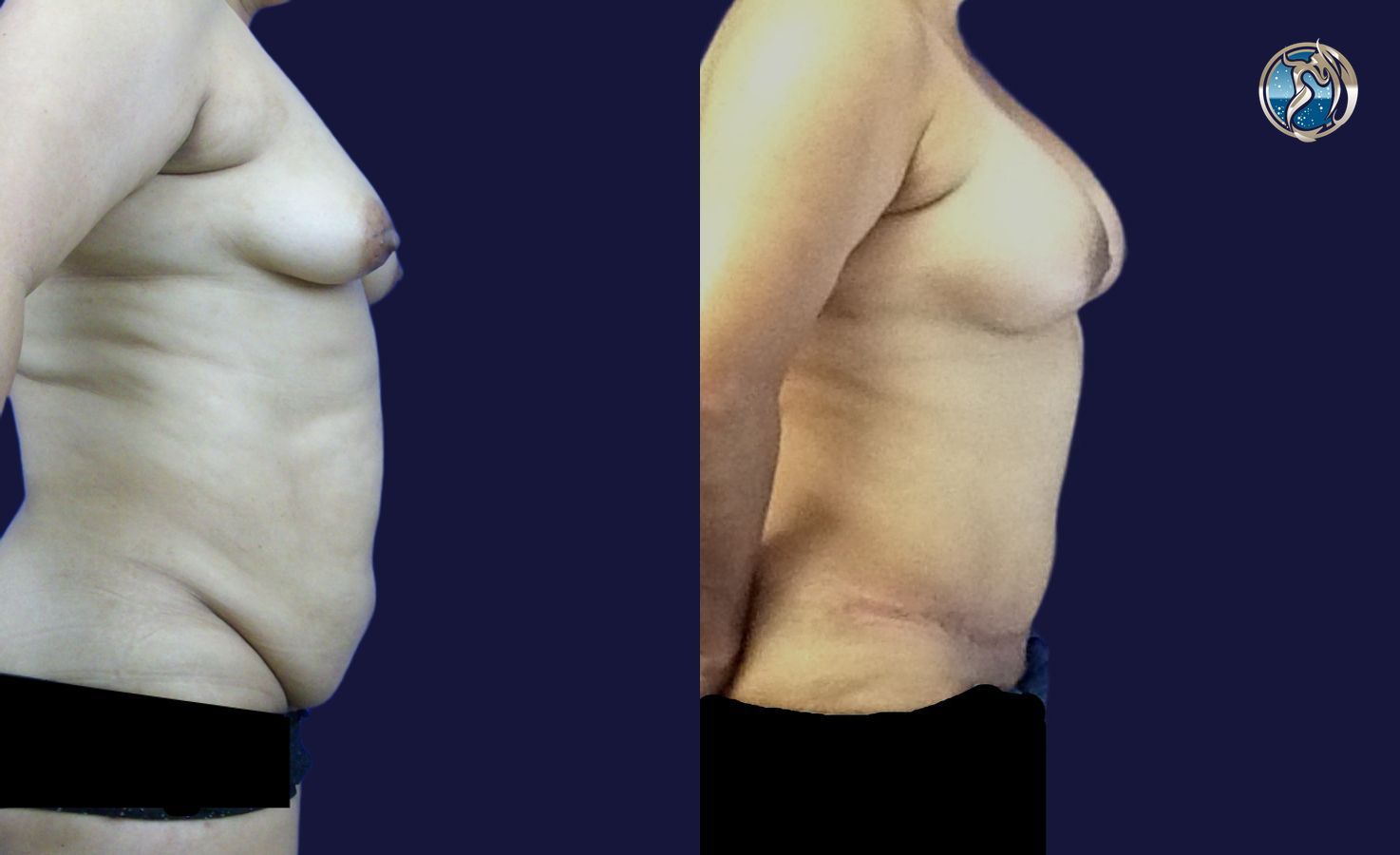 Before and after Combined Abdominal and Breast rejuvenation case 43770 - Angle 3