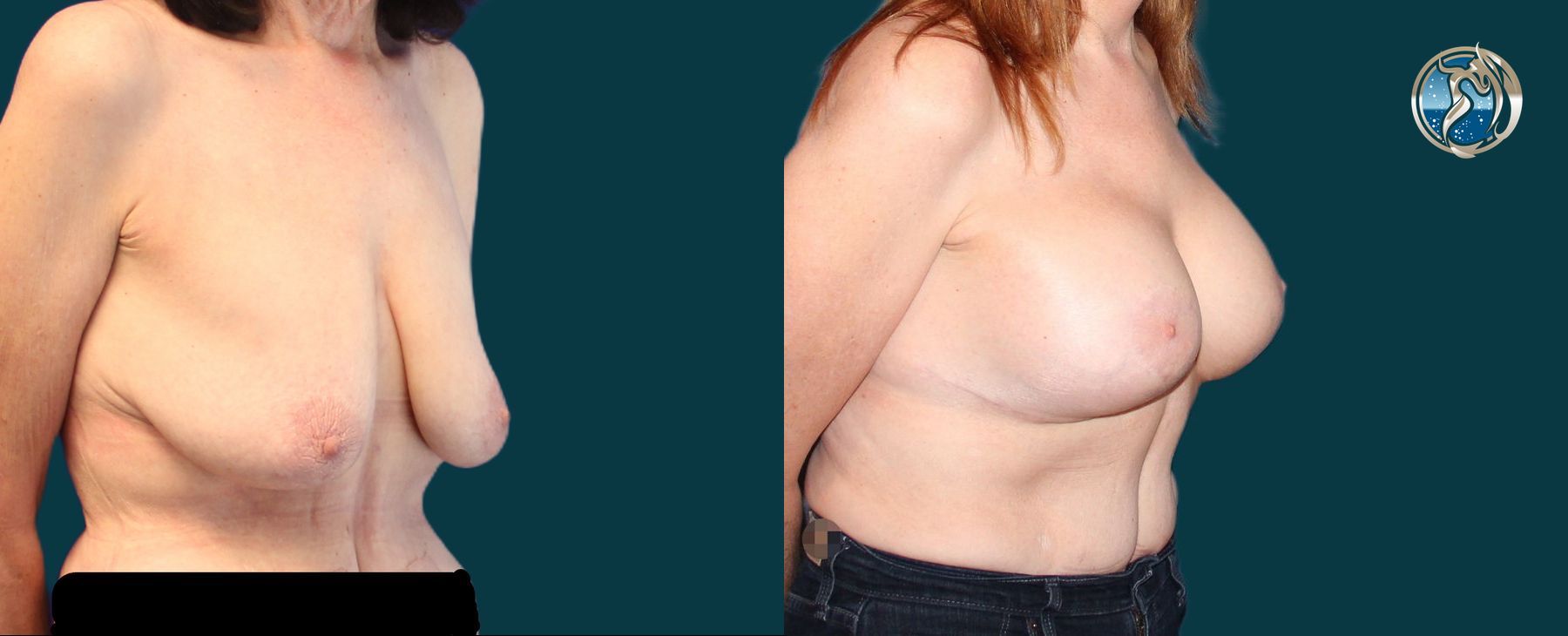 Before and after photo set of breast lift and augmentation by Dr. Orna Fisher in San Mateo, CA - Angle 3