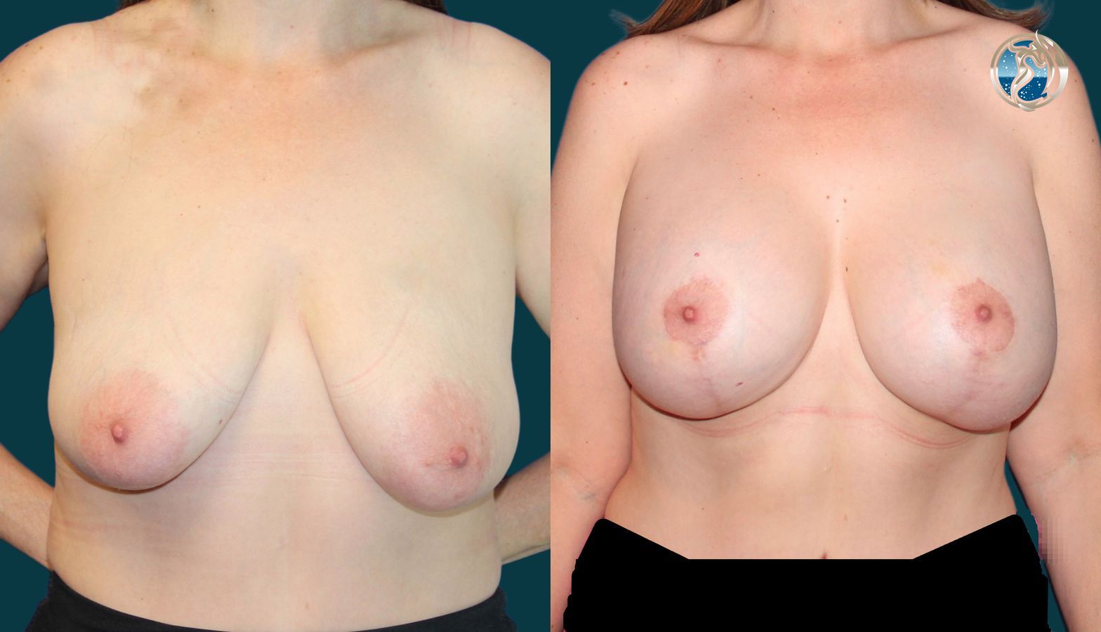 Before and after photo set of breast augmentation and breast lift by Dr. Orna Fisher in San Mateo, CA - Angle 4