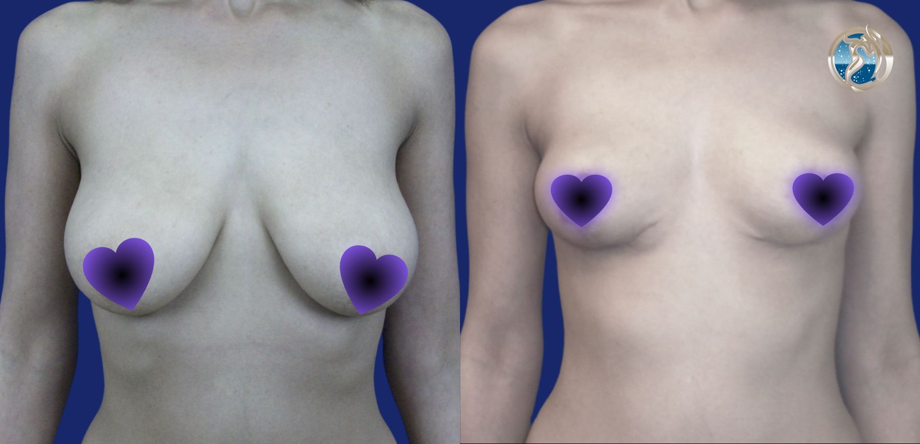 Before and after Breast Lift (Mastopexy) case 46020