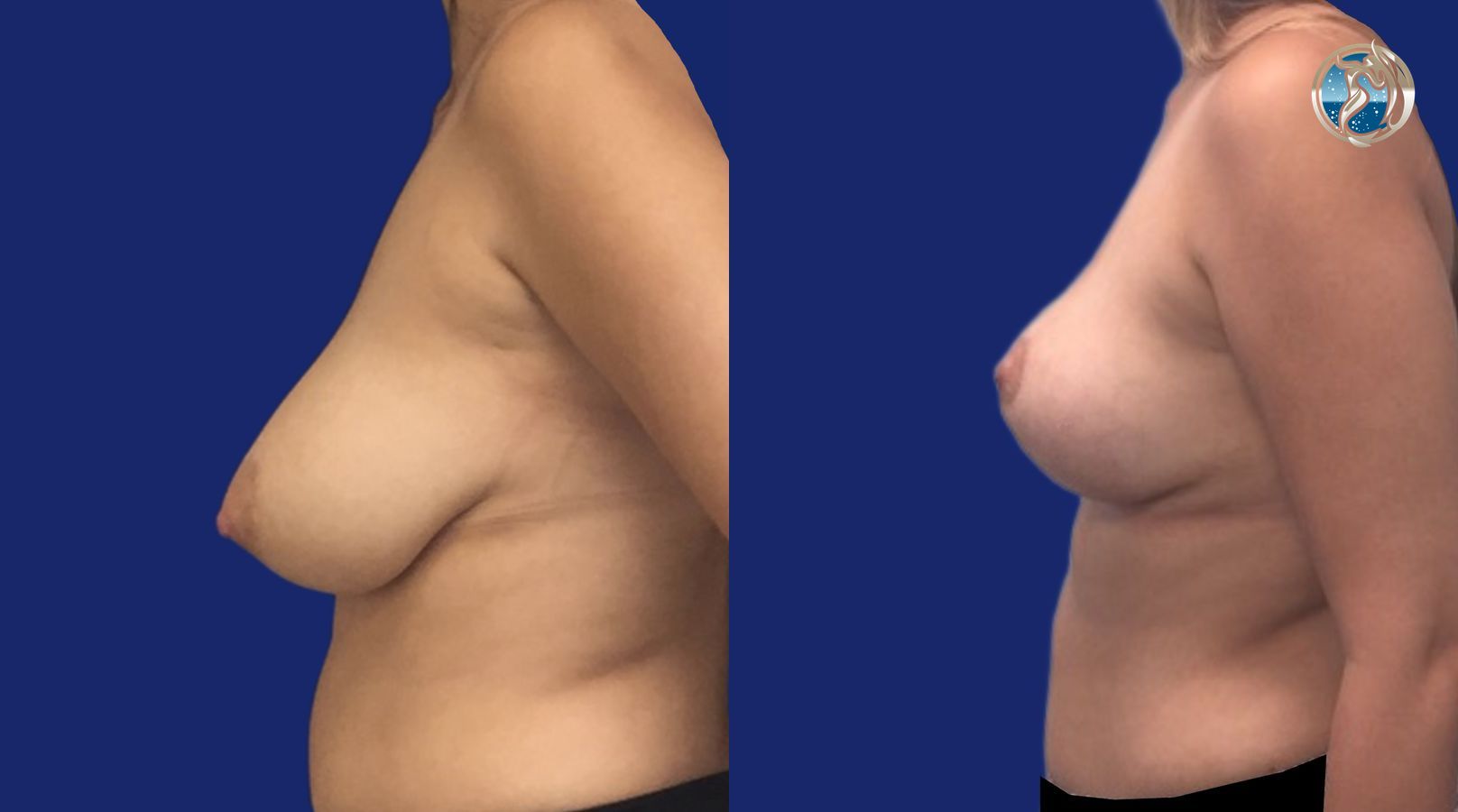 Before and after Breast Lift (Mastopexy) case 46112 - Angle 3