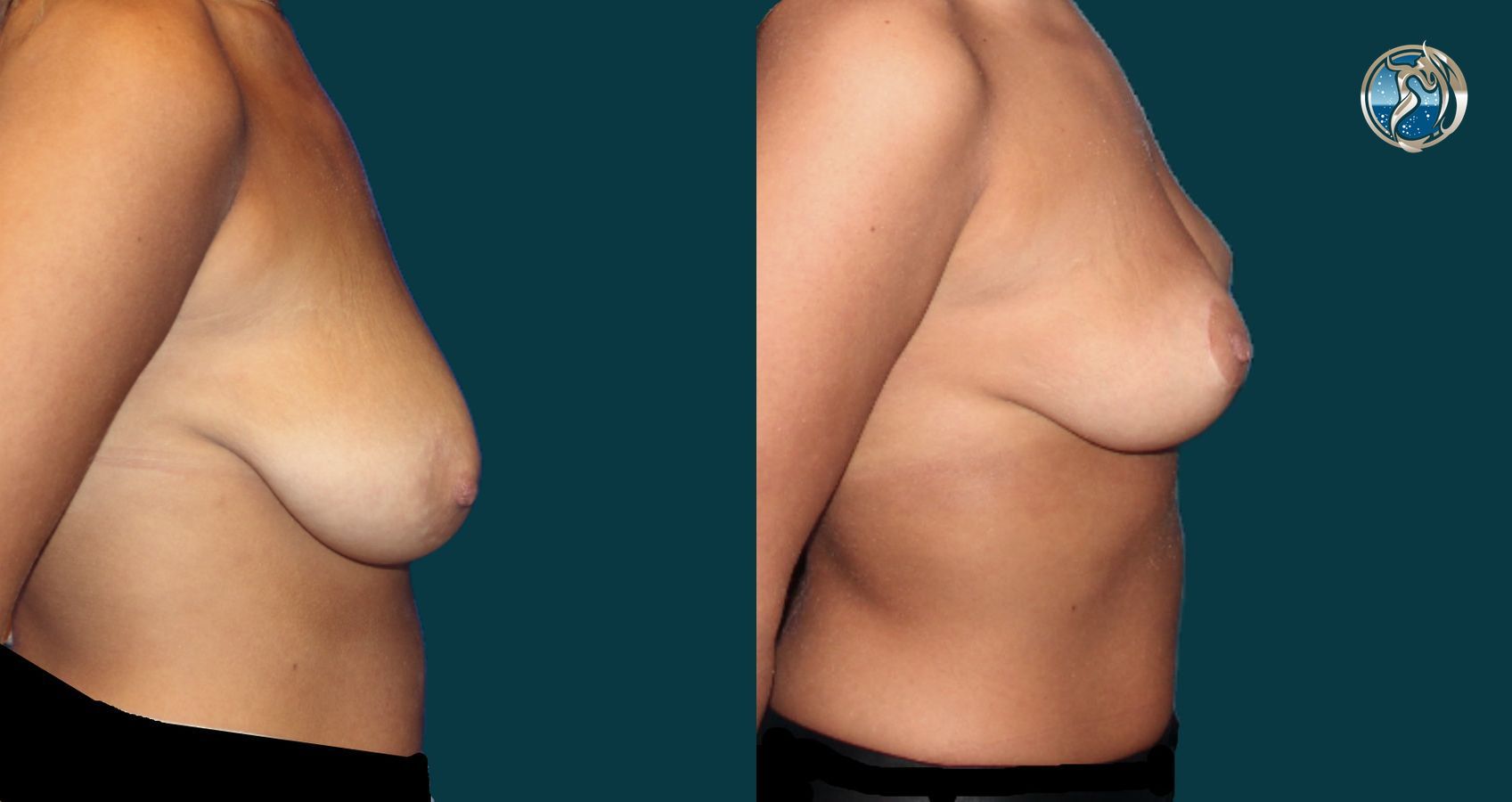 Before and after photo set of breast lift by Dr. Orna Fisher in San Mateo, CA - Angle 4