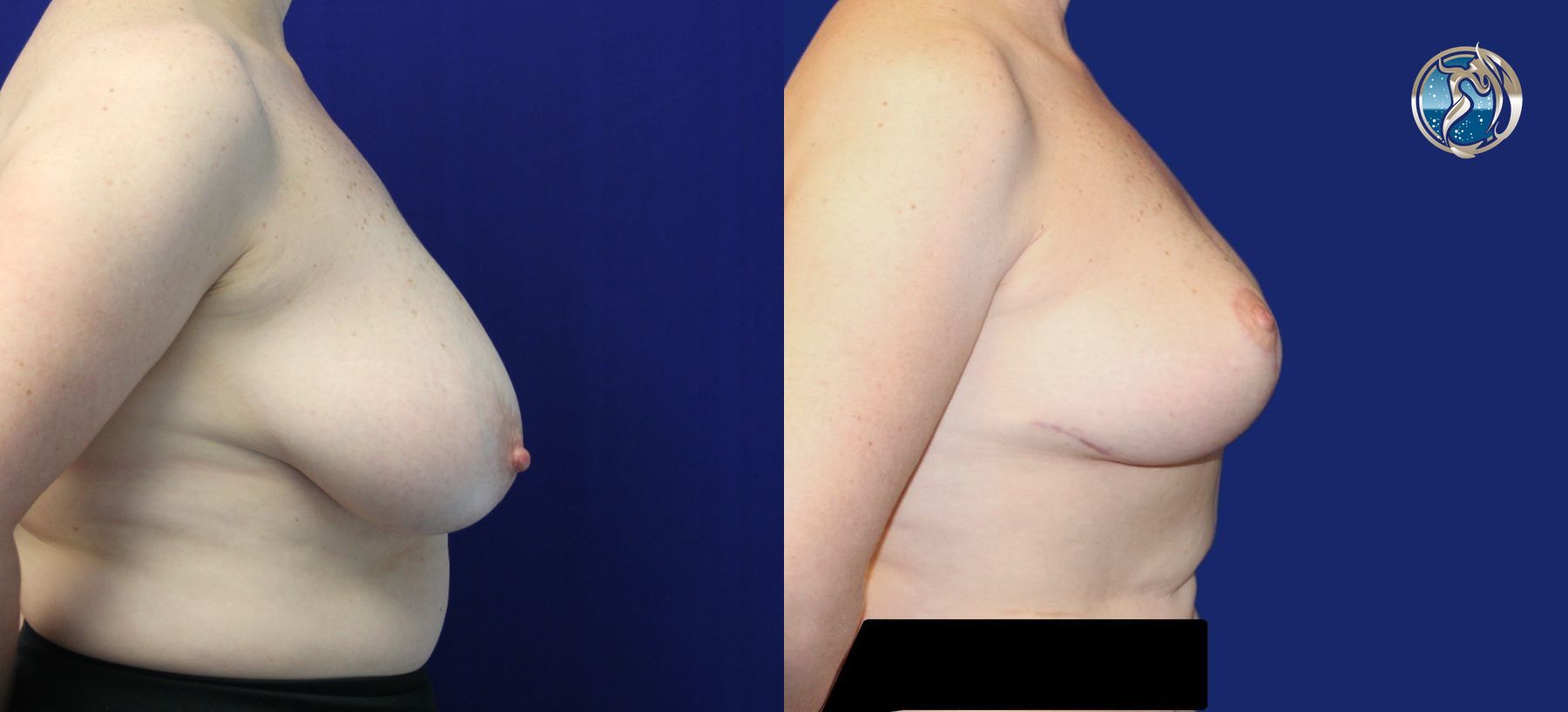 Before and after photo set of breast lift by Dr. Orna Fisher in San Mateo, CA - Angle 5