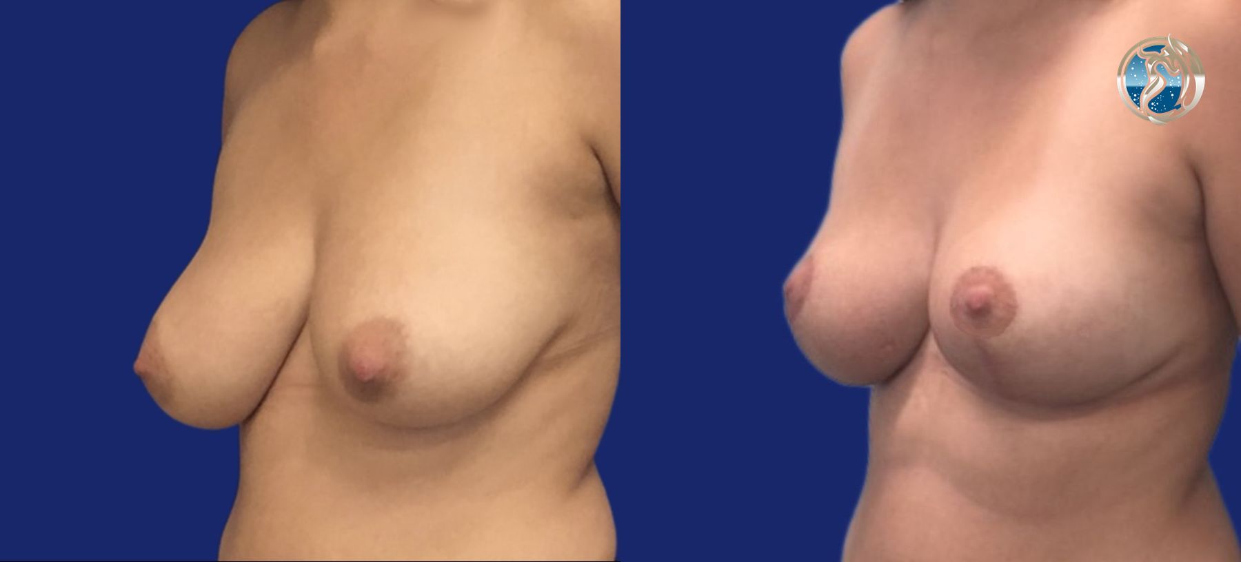 Before and after Breast Lift (Mastopexy) case 46112 - Angle 5