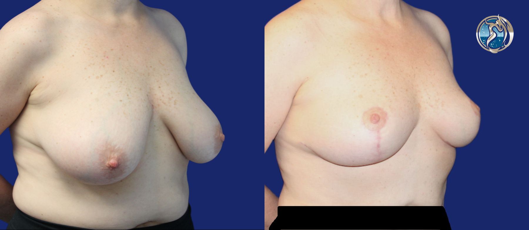 Before and after photo set of breast lift by Dr. Orna Fisher in San Mateo, CA - Angle 4