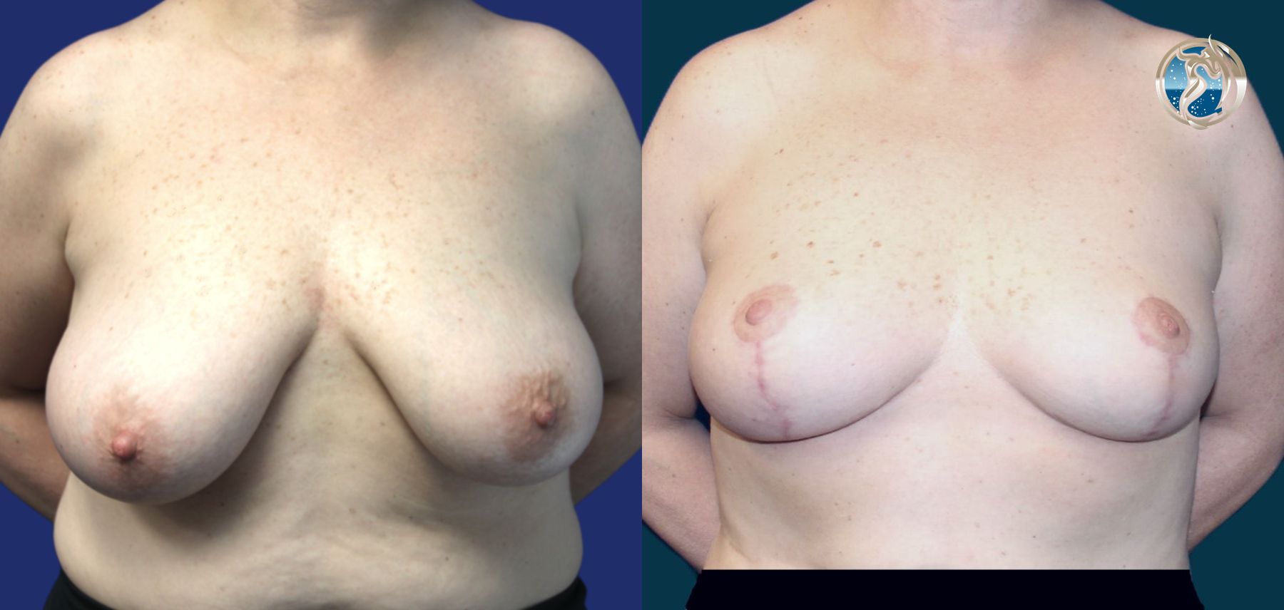 Before and after photo set of breast lift by Dr. Orna Fisher in San Mateo, CA