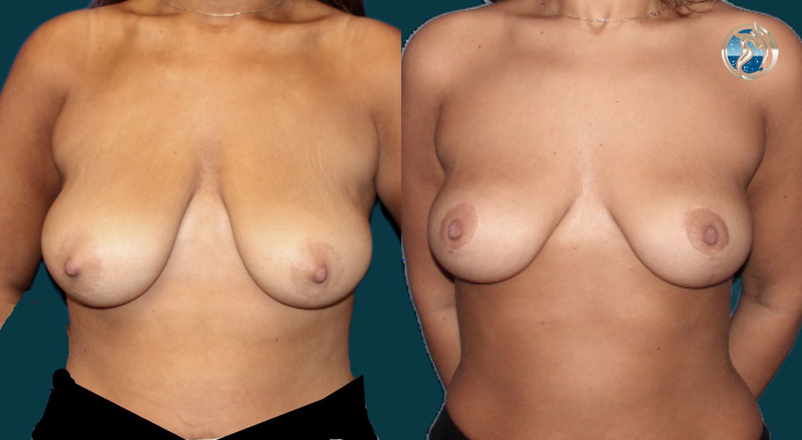 Before and after photo set of breast lift by Dr. Orna Fisher in San Mateo, CA