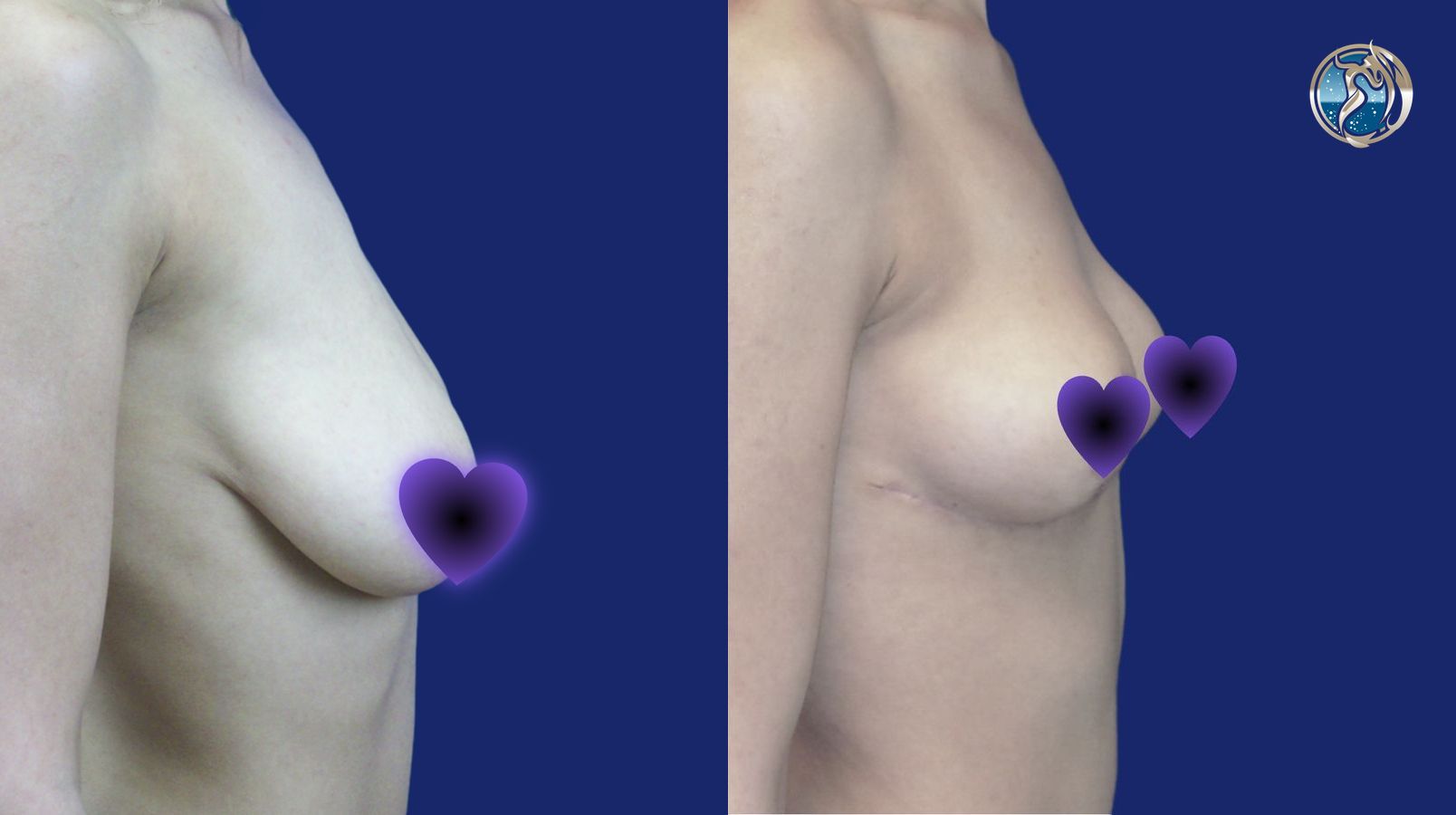 Before and after Breast Lift (Mastopexy) case 46020 - Angle 2