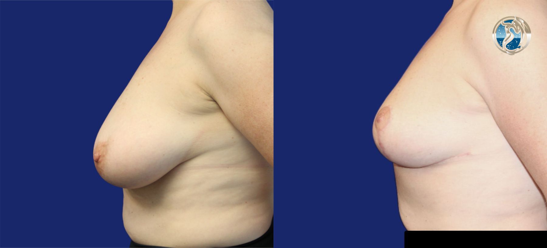 Before and after photo set of breast lift by Dr. Orna Fisher in San Mateo, CA - Angle 3