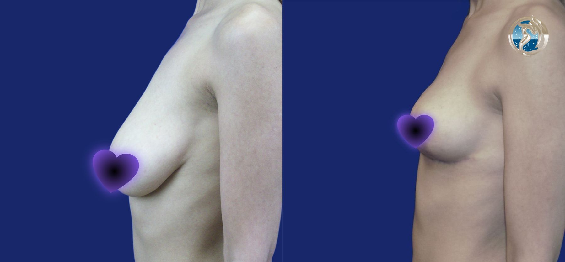 Before and after Breast Lift (Mastopexy) case 46020 - Angle 4