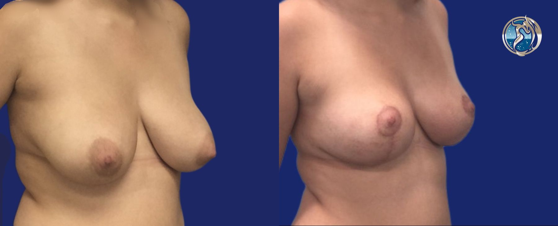 Before and after Breast Lift (Mastopexy) case 46112 - Angle 2