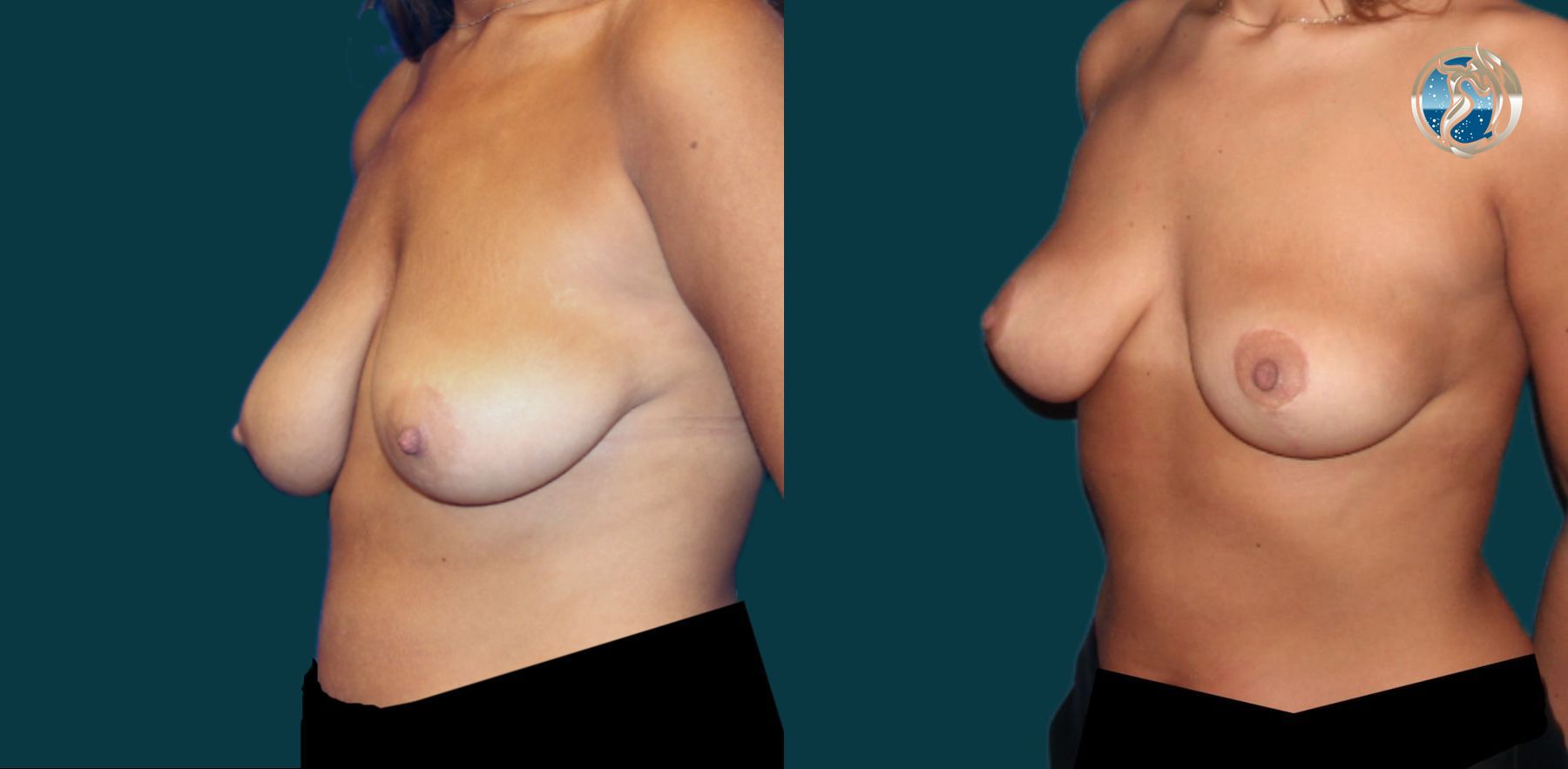 Before and after photo set of breast lift by Dr. Orna Fisher in San Mateo, CA - Angle 2