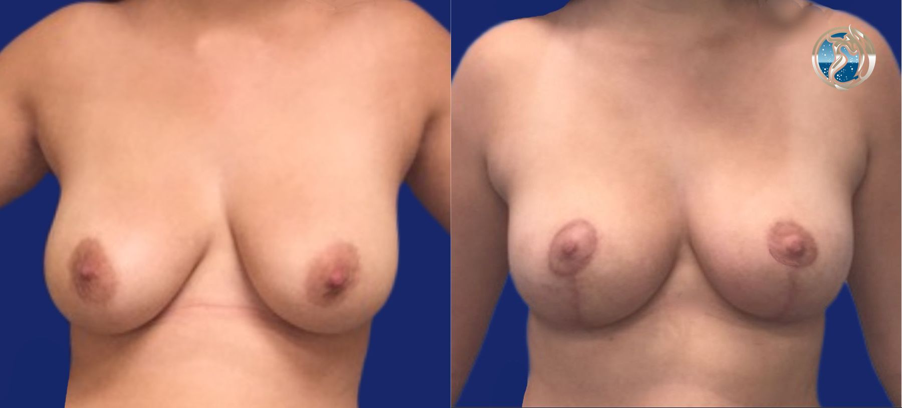 Before and after Breast Lift (Mastopexy) case 46112