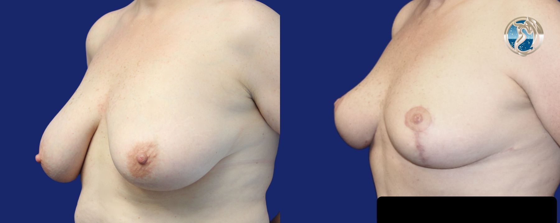 Before and after photo set of breast lift by Dr. Orna Fisher in San Mateo, CA - Angle 2