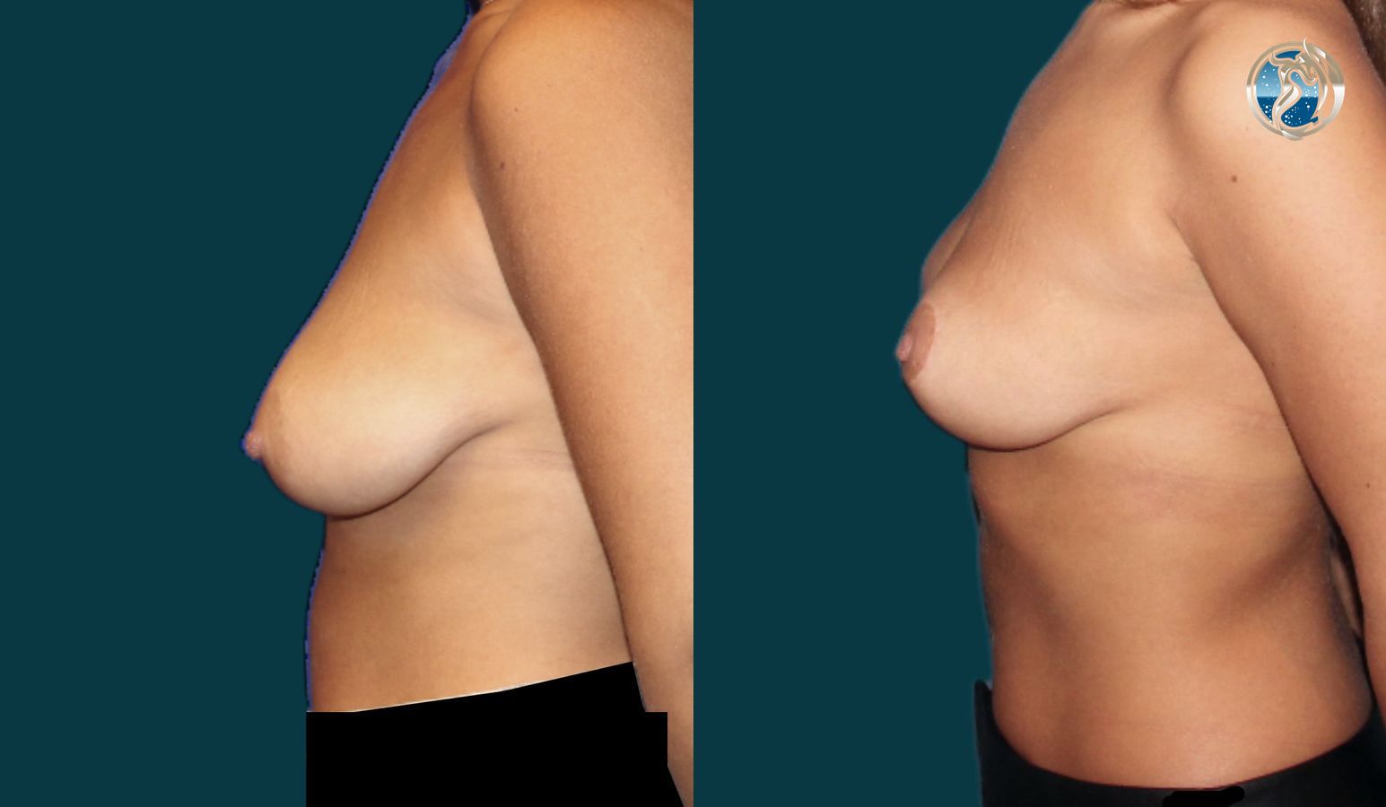 Before and after photo set of breast lift by Dr. Orna Fisher in San Mateo, CA - Angle 3