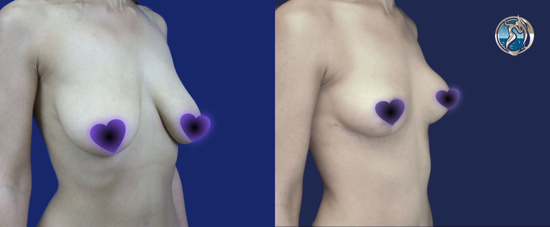 Before and after Breast Lift (Mastopexy) case 46020 - Angle 3