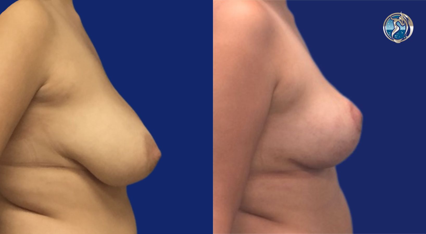 Before and after Breast Lift (Mastopexy) case 46112 - Angle 4