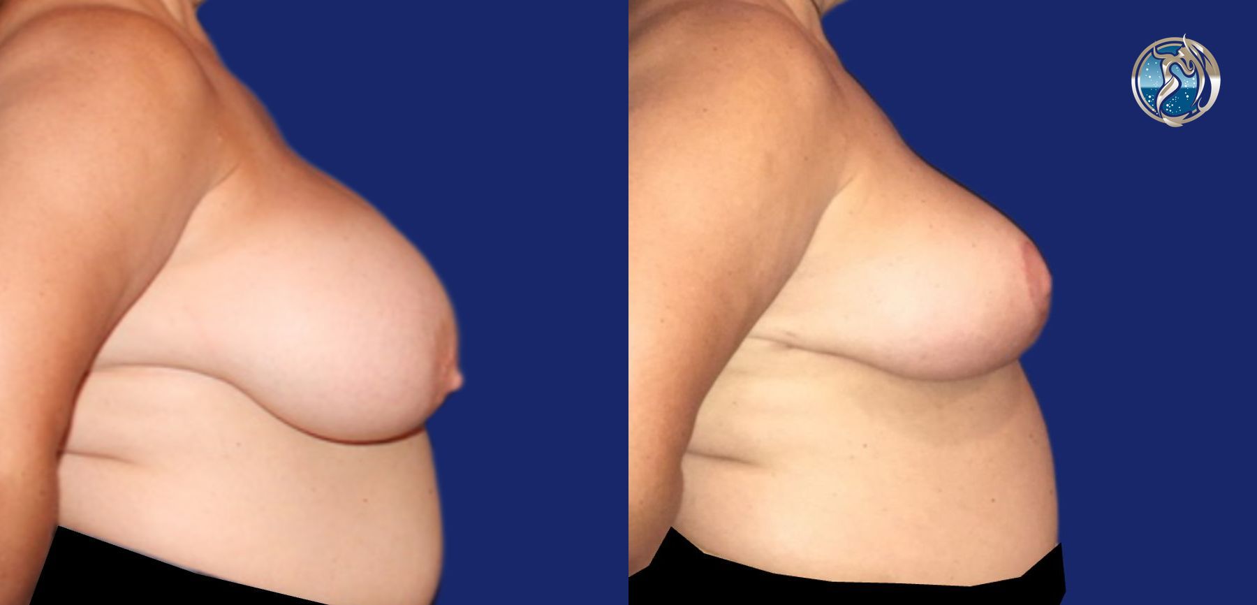 Before and after Breast Reduction case 46063 - Angle 3